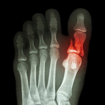 broken-toe-s5-diagnosed